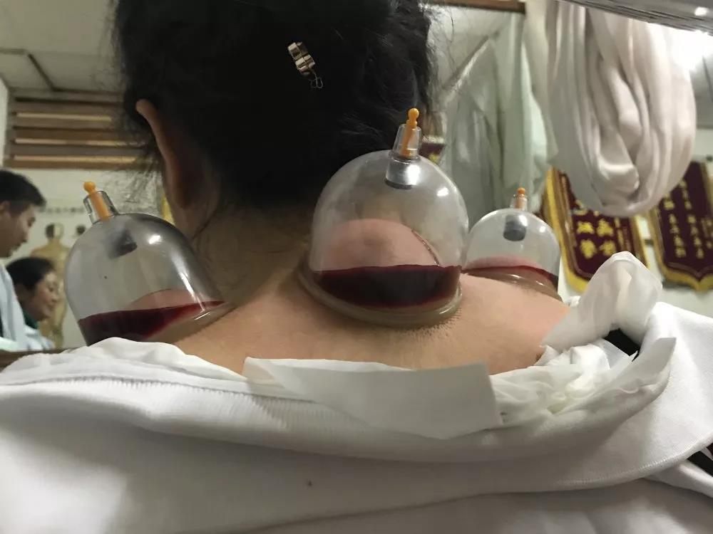 刺血療法對(duì)身體安全到底有沒(méi)有保障？